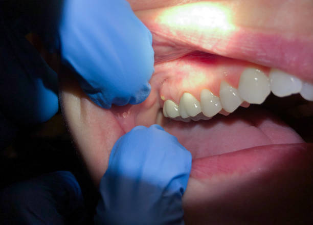 Best Urgent Care for Lost Fillings or Crowns in Murphysboro, IL